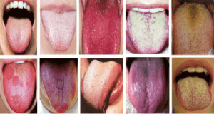 Witte tong oorzaken