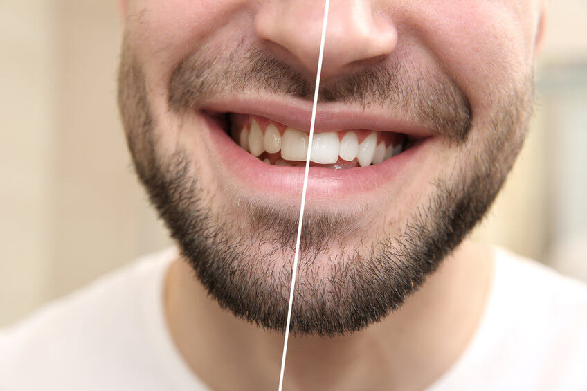 Tanden Bleken? Top Beste Middelen (TIP) - Tandartswiki