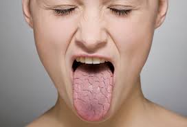 Tonsil stones door droge mond