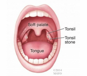 Witte brokjes in je keel