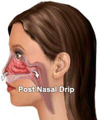 Post-nasale drip